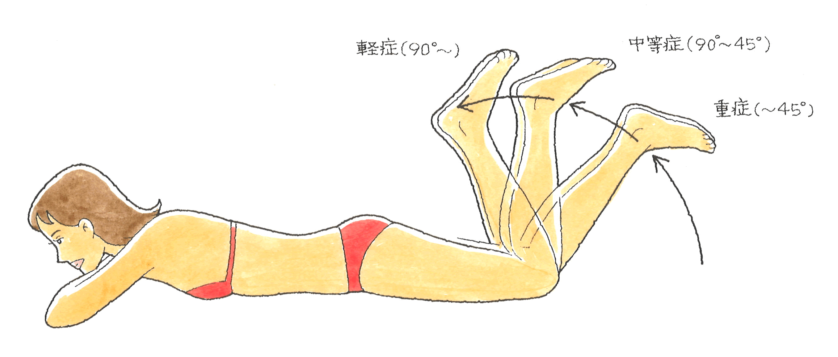 肉離れ⑤.gif