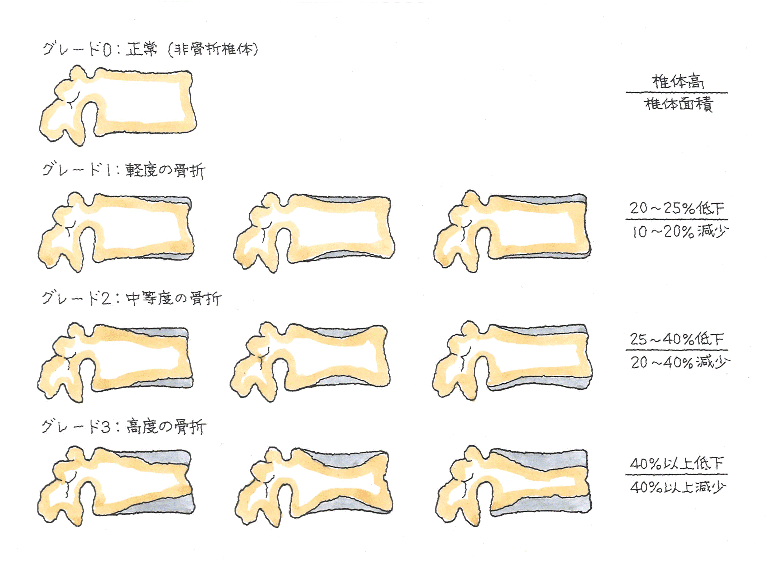 脊柱のグレード.gif