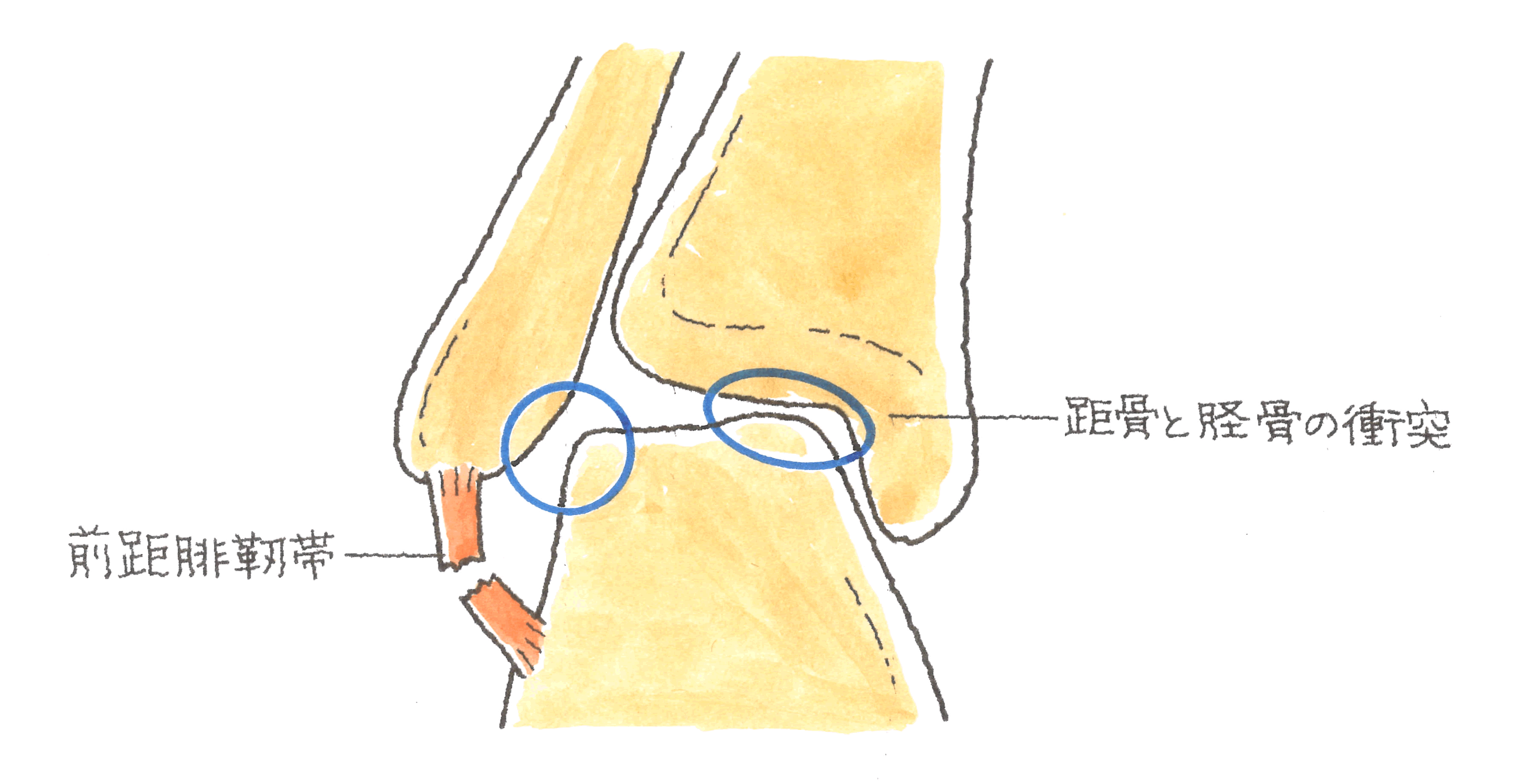 衝突図.gif