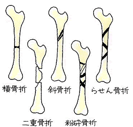 骨折の種類.gif